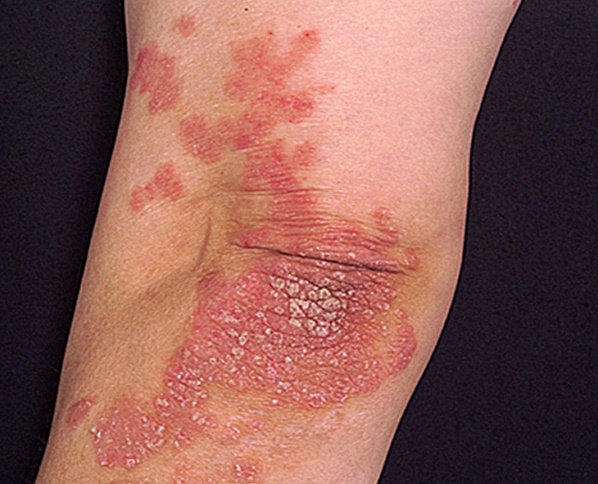 Psoriasis